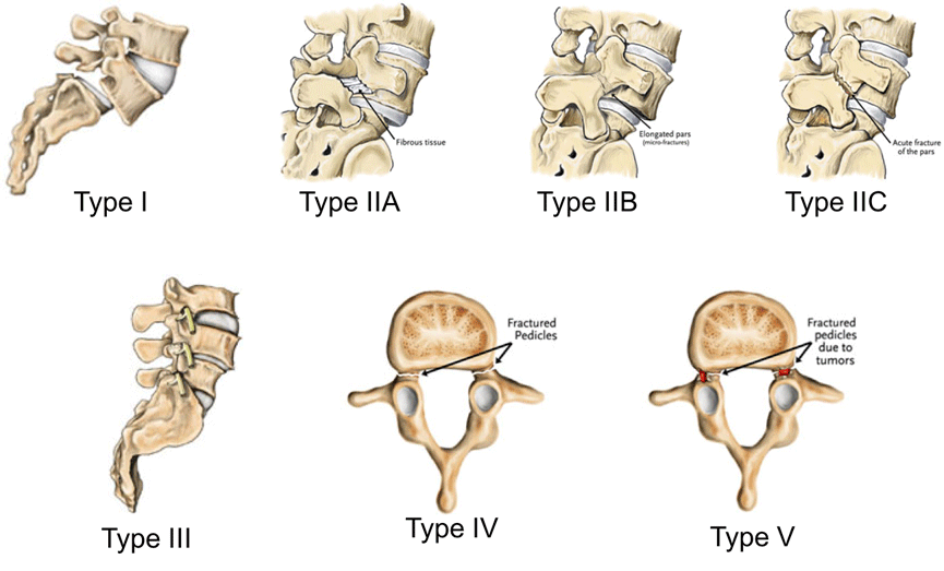 Spondylolisthesis