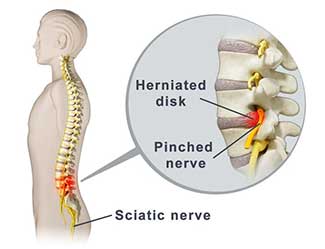pinched nerve in the lower back