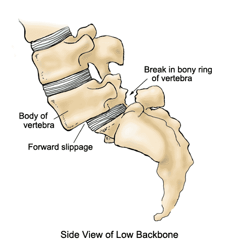 Spondylolisthesis side view