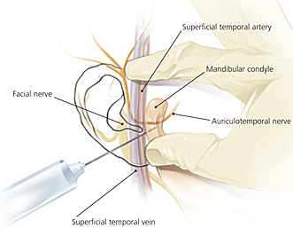 tmj-injection-diagram