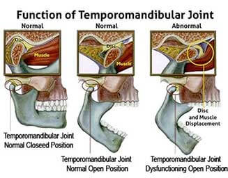 Jaw Pain / Temporomandibular Joint Pain | Complete Spine and Pain Care