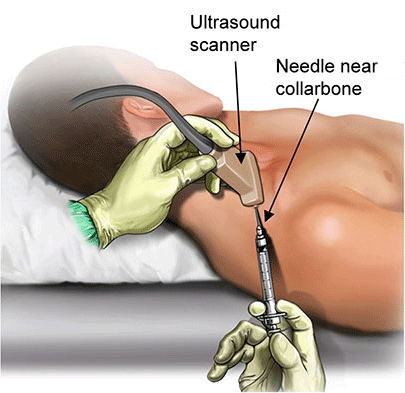 Ultrasound-Guided Injection for Pain Relief