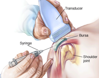 Subacromial steroid injection cpt code