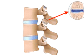 Facet Disease / Facet Syndrome