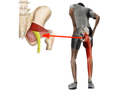 Piriformis Syndrome