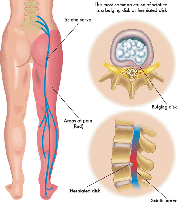 Sciatic Back Pain