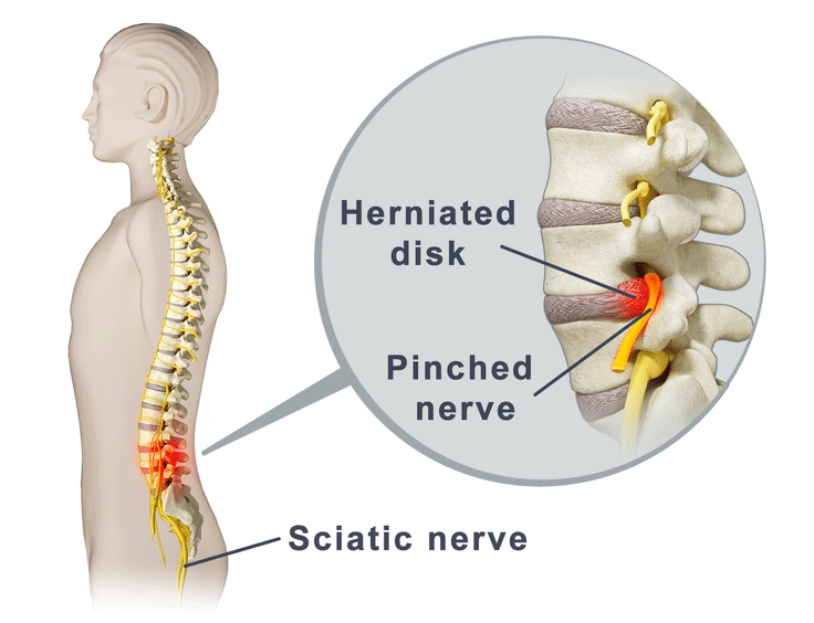 Sciatica (Pinched Nerve) Causes, Symptoms & Treatments